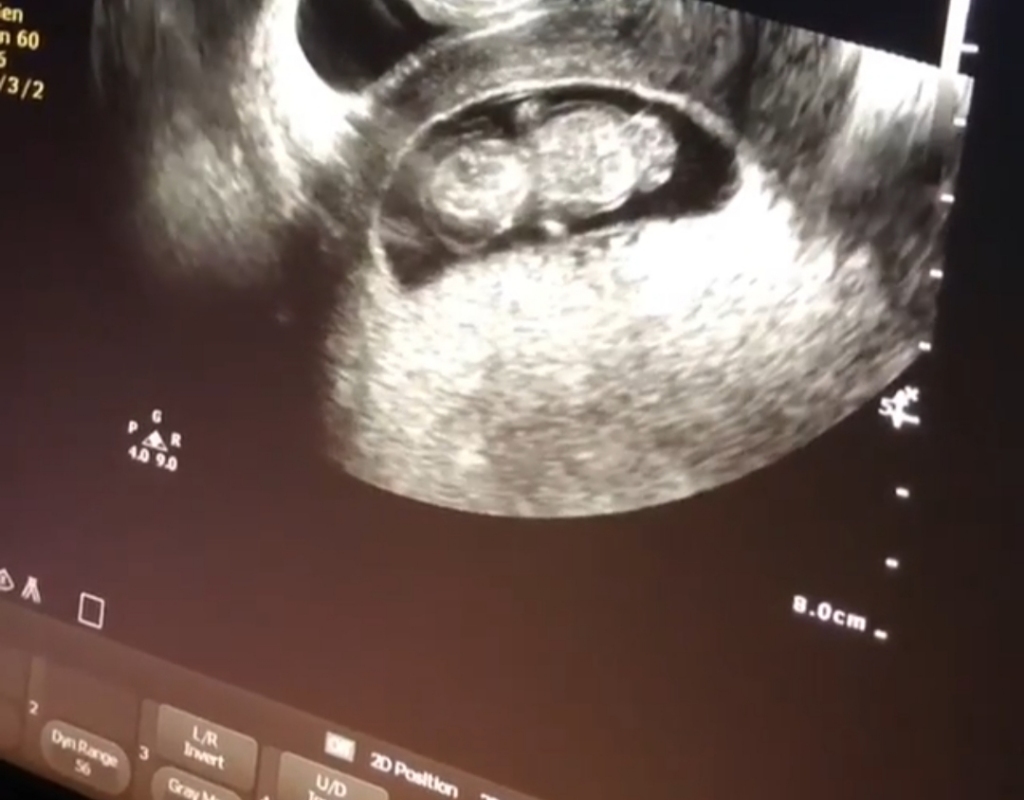 A snippet from the ultrasound video of Joanna when she was pregnant with Crew